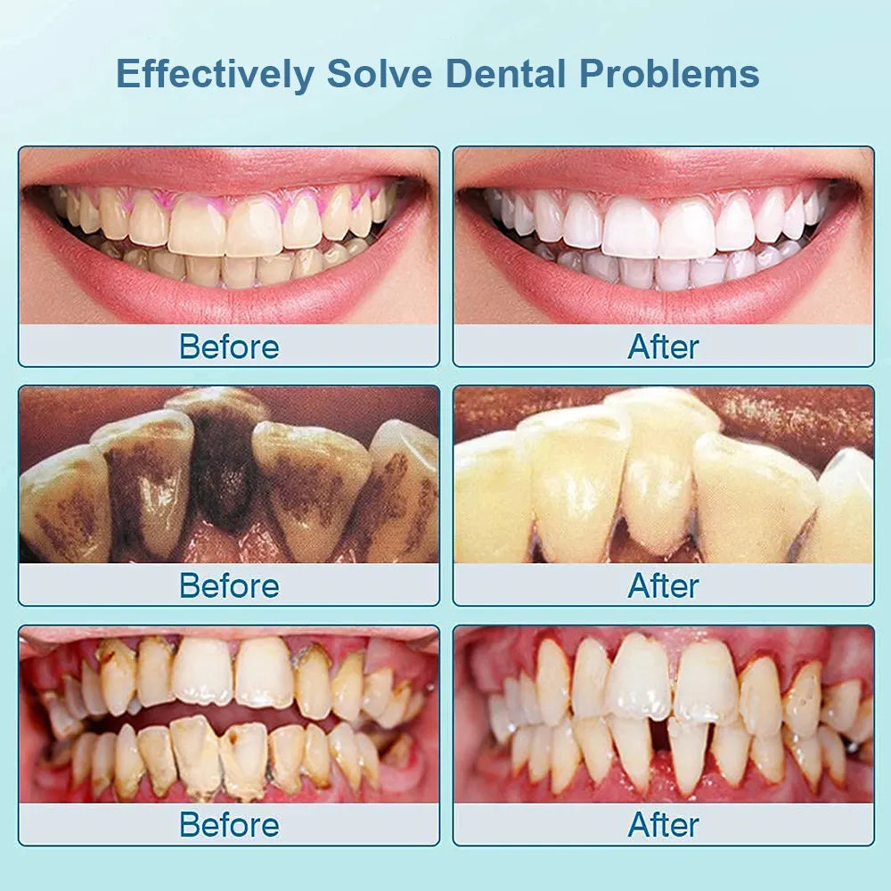 Ultrasonic Dental Stain, Tartar, & Calculus Remover For Teeth