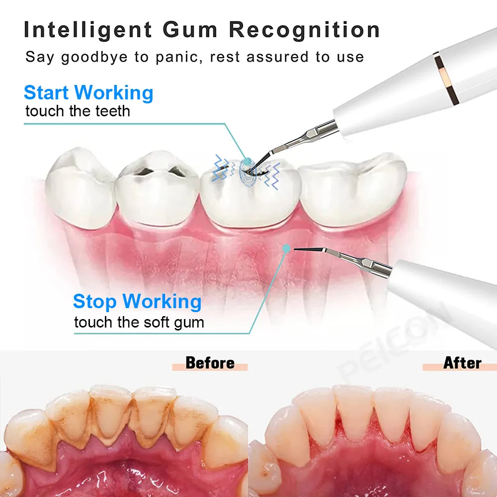 Ultrasonic Dental Stain, Tartar, & Calculus Remover For Teeth