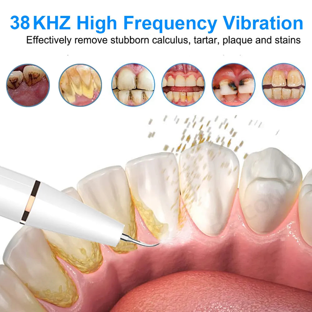 Ultrasonic Dental Stain, Tartar, & Calculus Remover For Teeth